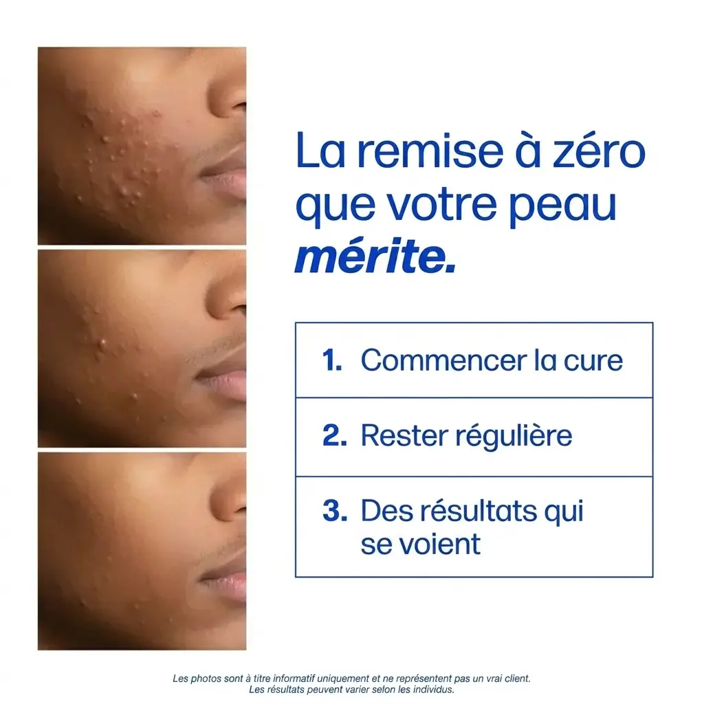 MYVA™ Anti-Acné Hormonale