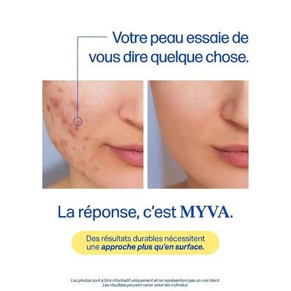 MYVA™ Anti-Acné Hormonale